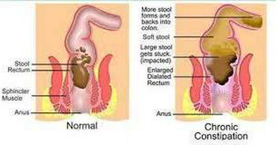 Chiro-Klenz Detox Tea for Colon Cleanse Natural Herbal Tea for Bloating Relief and Weight Loss for Women and Men / Gentle Cleansing Action for Full Body Detox / No Sugar, Caffeine, or Gluten