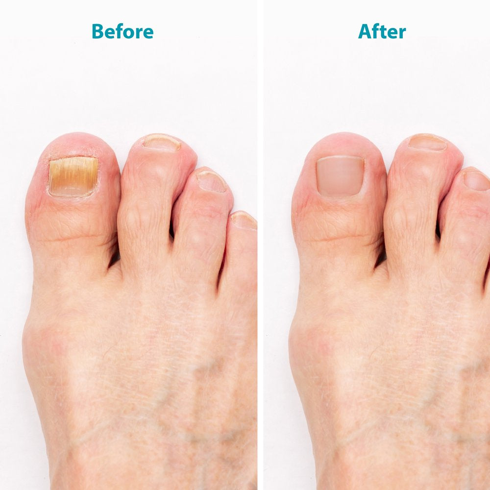 Candida Cleanse Fungus Eliminator, Powerful Oregano Supplement with Caprylic Acid and Oregano Oil Organic by Purehealth Research