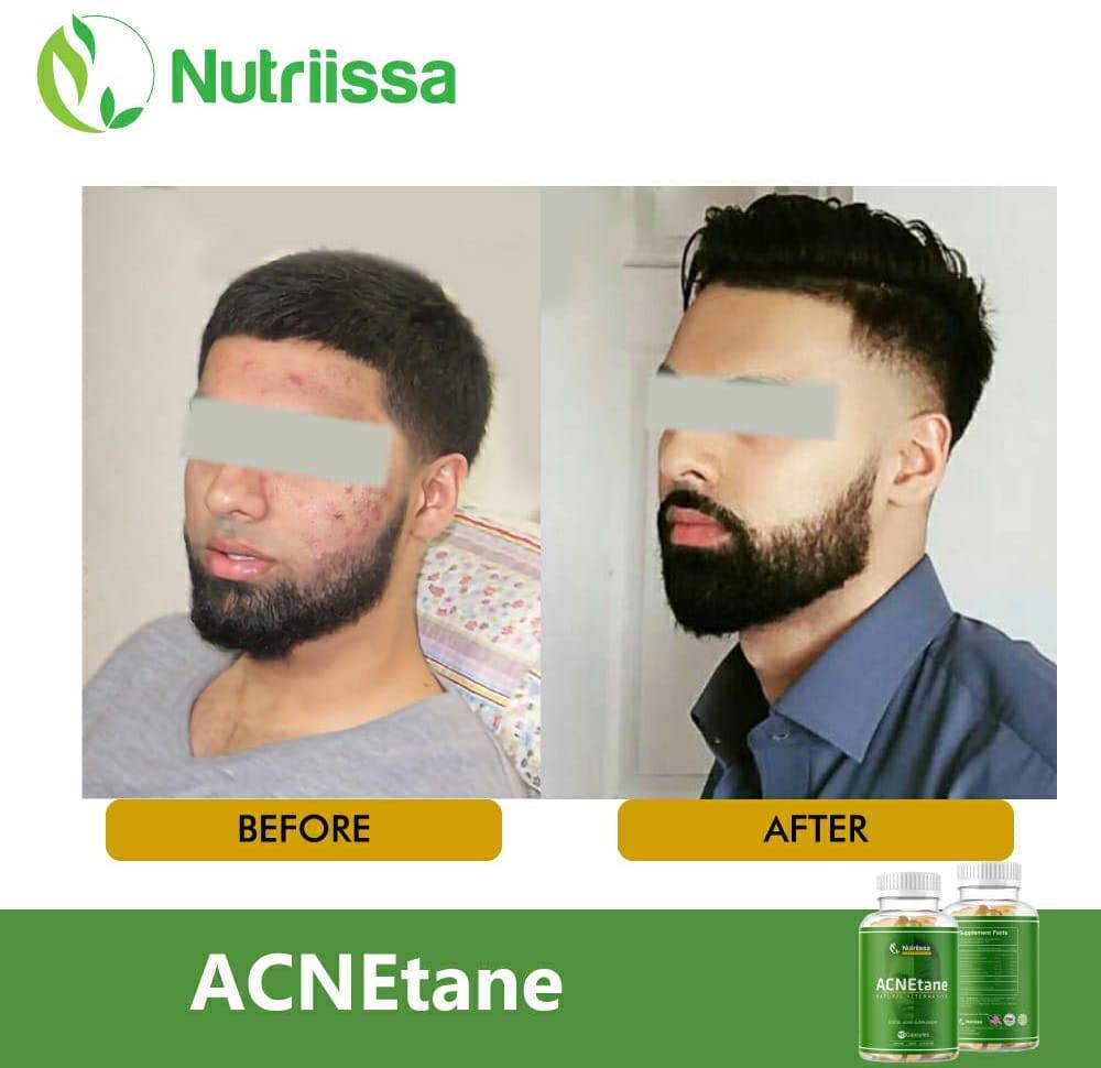 ACNEtane Vitamin Supplements by Nutriissa 180 Veggie Capsules All-Natural Dietary Supplement for Acne Proprietary Blend with Co-Enzyme Q10, L-Carnitine Ideal for Hormonal, Puberty, Cystic Acne
