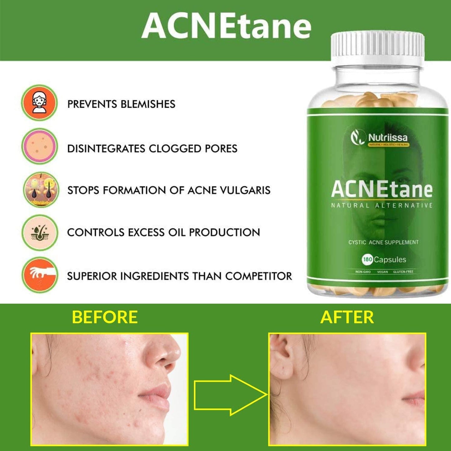 ACNEtane Vitamin Supplements by Nutriissa 180 Veggie Capsules All-Natural Dietary Supplement for Acne Proprietary Blend with Co-Enzyme Q10, L-Carnitine Ideal for Hormonal, Puberty, Cystic Acne