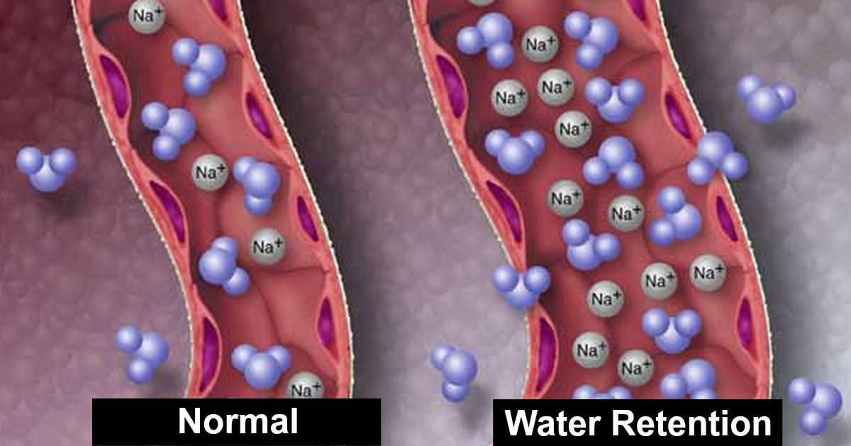 Natural Diuretic Water Pill Guaranteed to Eliminate Water Retention