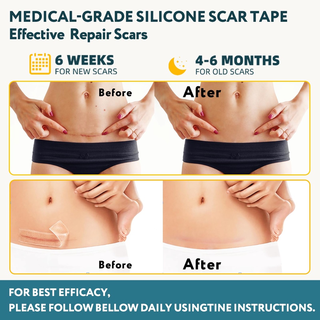 silicone-scar-tape-60-x-1-6-roll-1-5m-sc-3.jpg