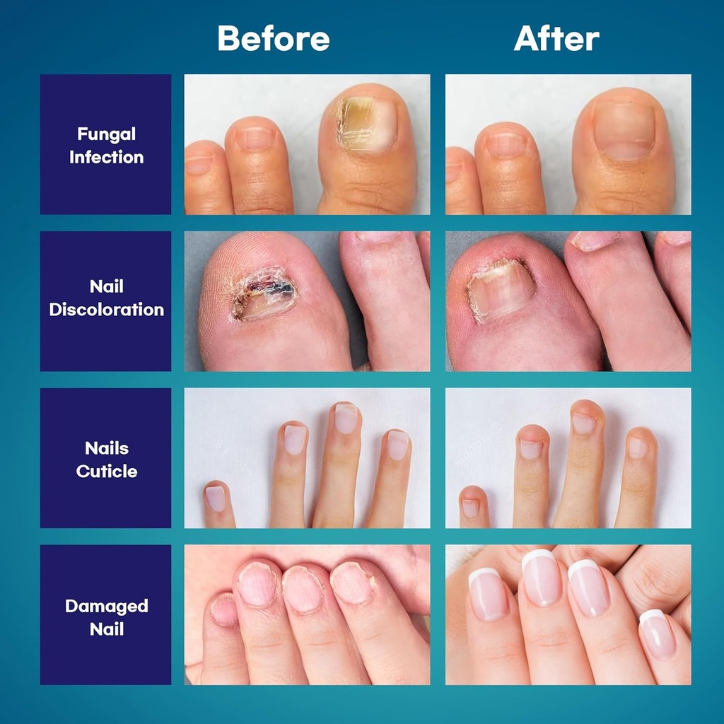 toenail-fungus-treatment-extra-strength--4.jpg