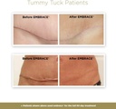 embrace-active-scar-defense-for-new-tumm-3.jpg
