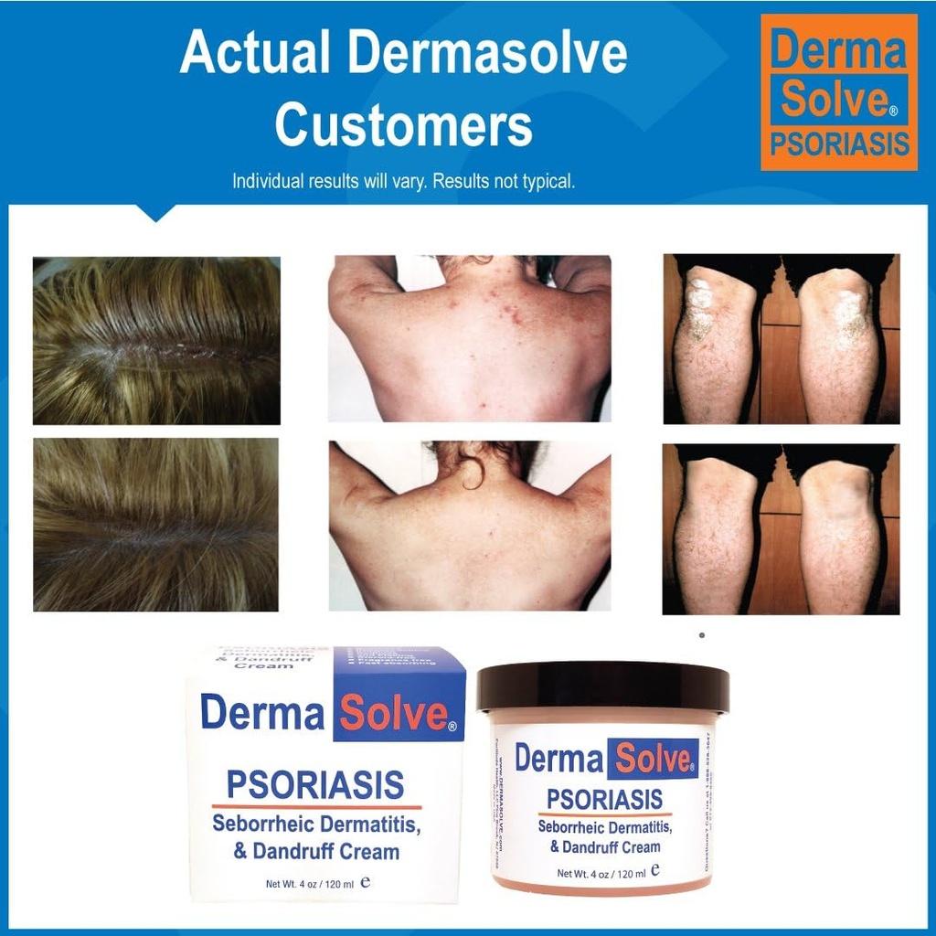 dermasolve-psoriasis-seborrheic-dermatit-5.jpg
