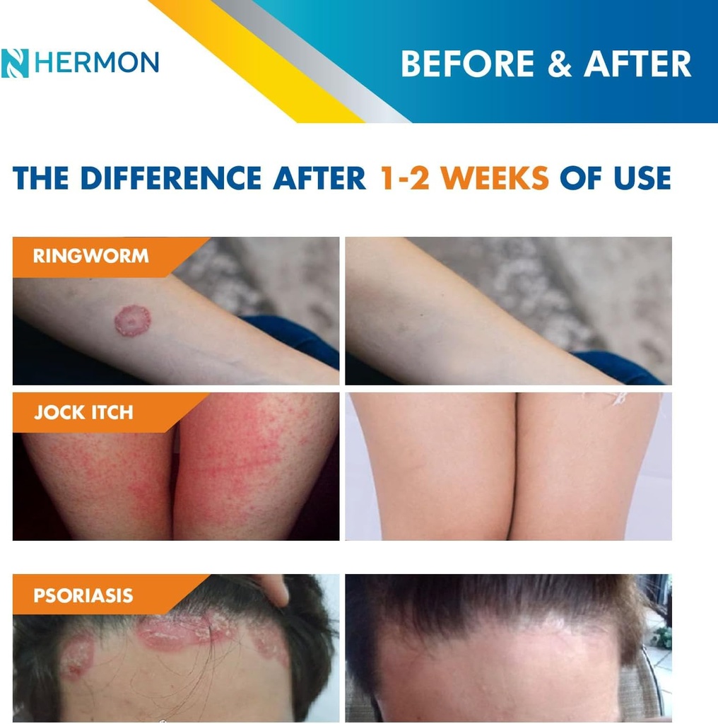 hermon-powerful-antifungal-ringworm-crea-2.jpg