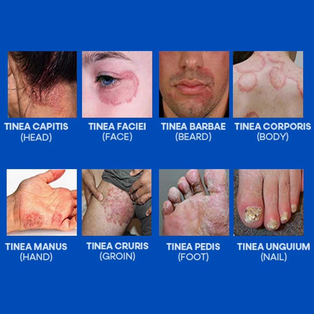 hermon-powerful-antifungal-ringworm-crea-6.jpg
