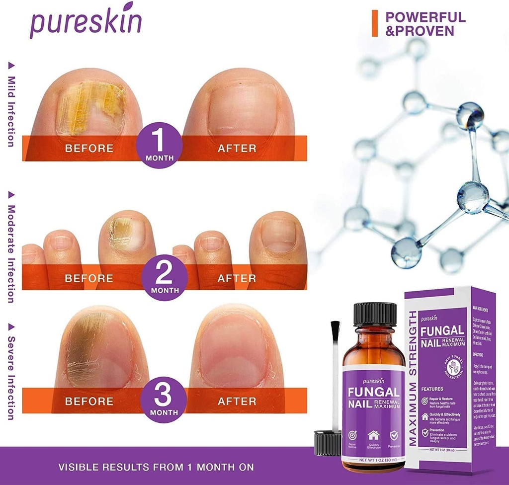 toenail-fungus-revitalizer-for-toenail-f-3.jpg