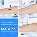 zip-stitch-laceration-repair-without-sti-3.jpg