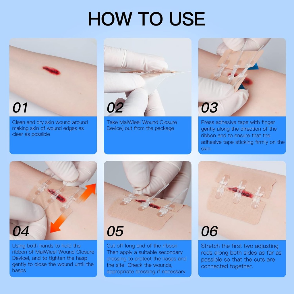 zip-stitch-laceration-repair-without-sti-6.jpg