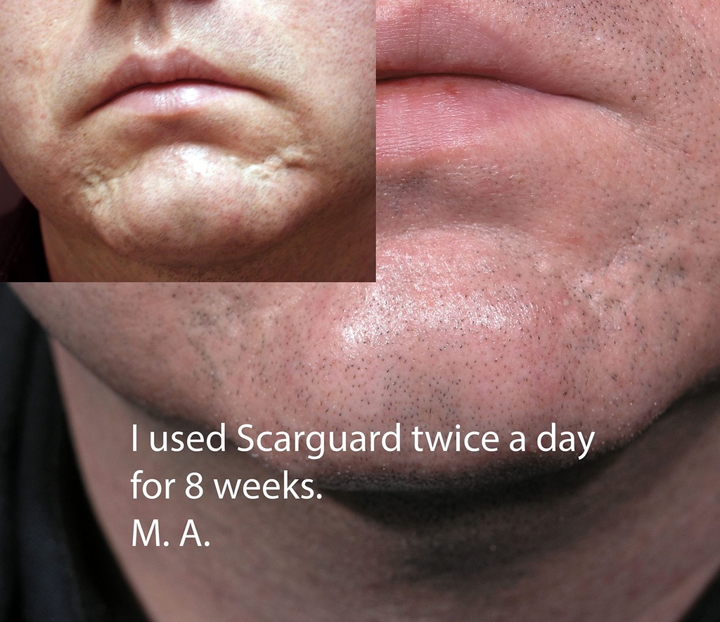 scarguard-invisible-brush-on-silicone-sh-5.jpg
