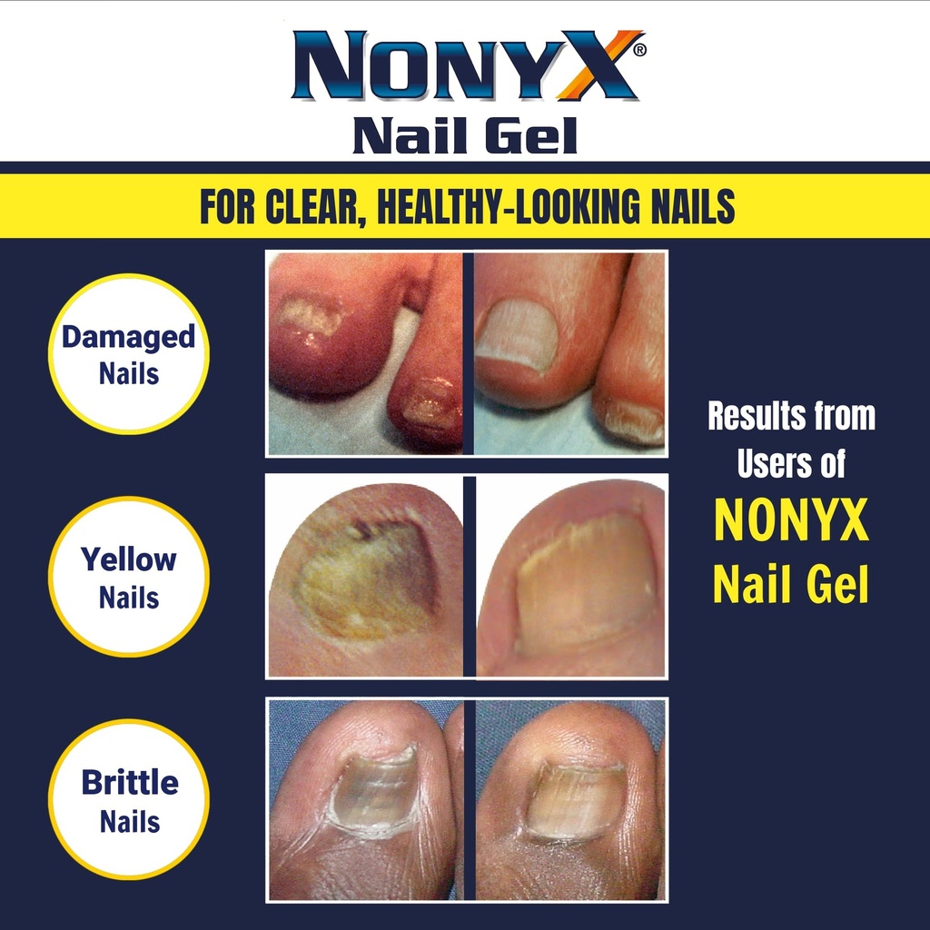 nonyx-fungal-nail-clarifying-gel-clinica-5.jpg